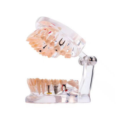 32 दांत पूर्ण माह इम्प्लांट रोग दांत मॉडल स्पष्ट डिजाइन दंत रोग विज्ञान मॉडल